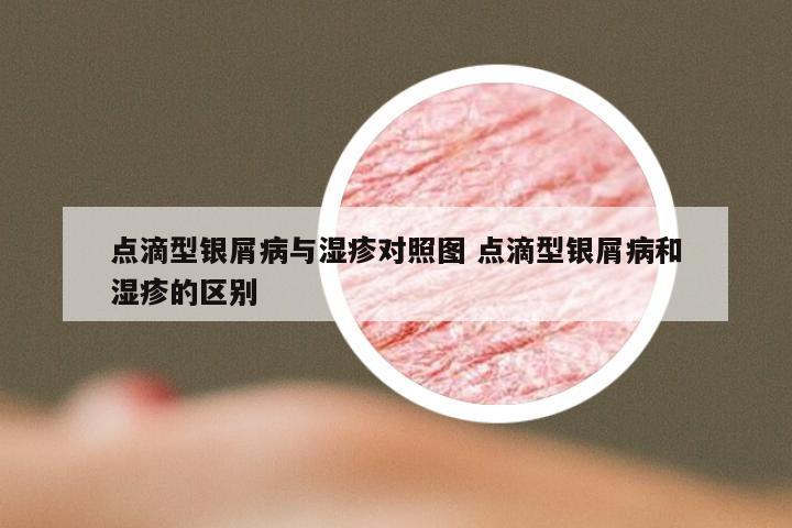 点滴型银屑病与湿疹对照图 点滴型银屑病和湿疹的区别
