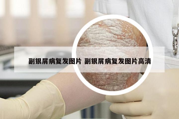 副银屑病复发图片 副银屑病复发图片高清
