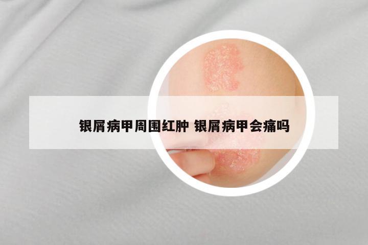 银屑病甲周围红肿 银屑病甲会痛吗