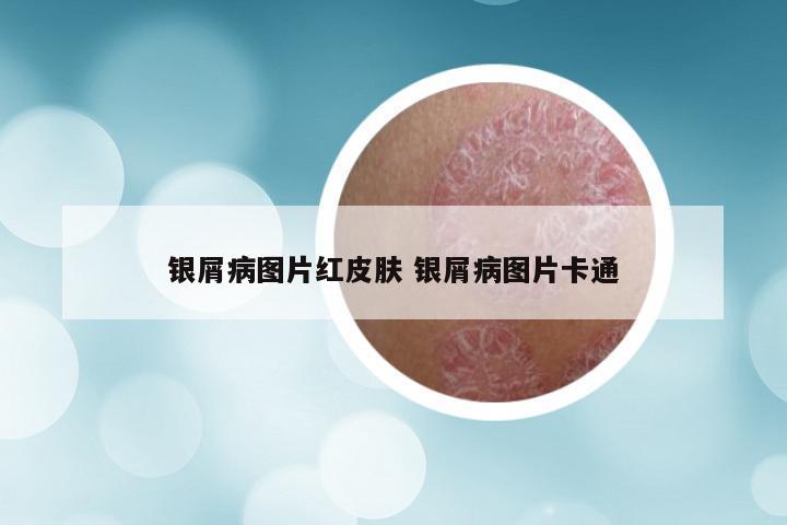 银屑病图片红皮肤 银屑病图片卡通