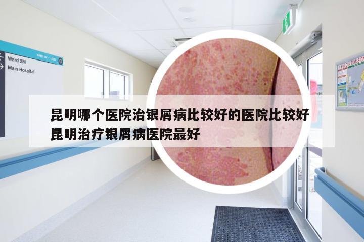 昆明哪个医院治银屑病比较好的医院比较好 昆明治疗银屑病医院最好