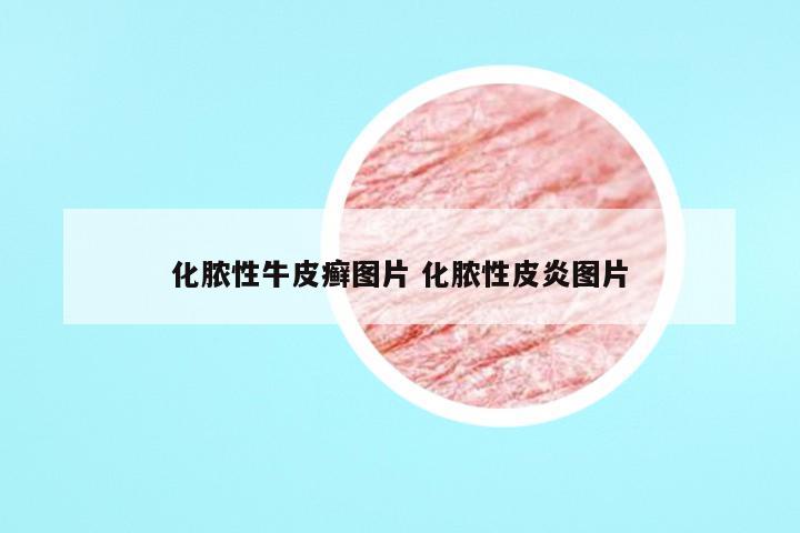 化脓性牛皮癣图片 化脓性皮炎图片