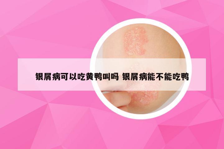银屑病可以吃黄鸭叫吗 银屑病能不能吃鸭