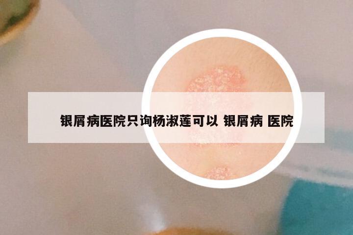 银屑病医院只询杨淑莲可以 银屑病 医院