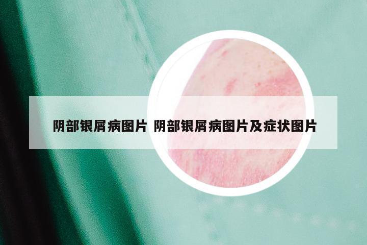 阴部银屑病图片 阴部银屑病图片及症状图片