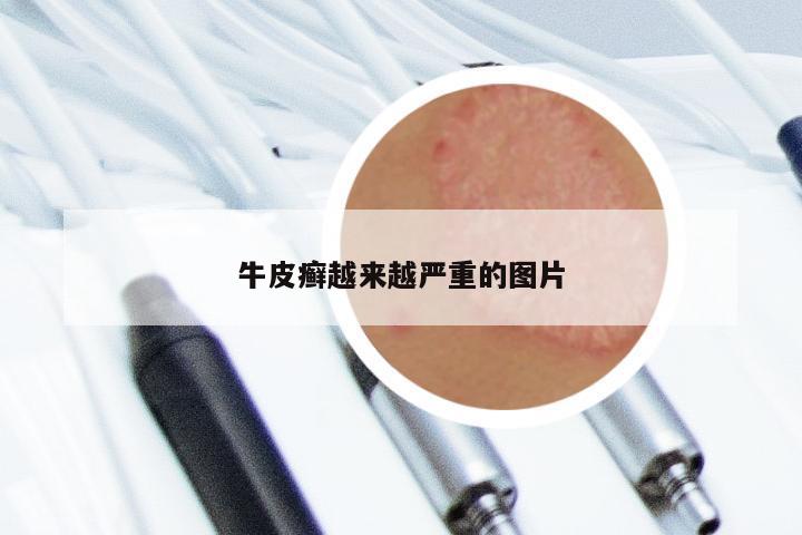 牛皮癣越来越严重的图片