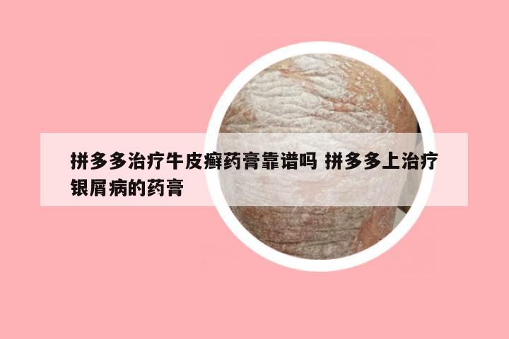 拼多多治疗牛皮癣药膏靠谱吗 拼多多上治疗银屑病的药膏