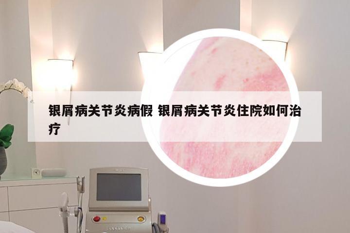 银屑病关节炎病假 银屑病关节炎住院如何治疗