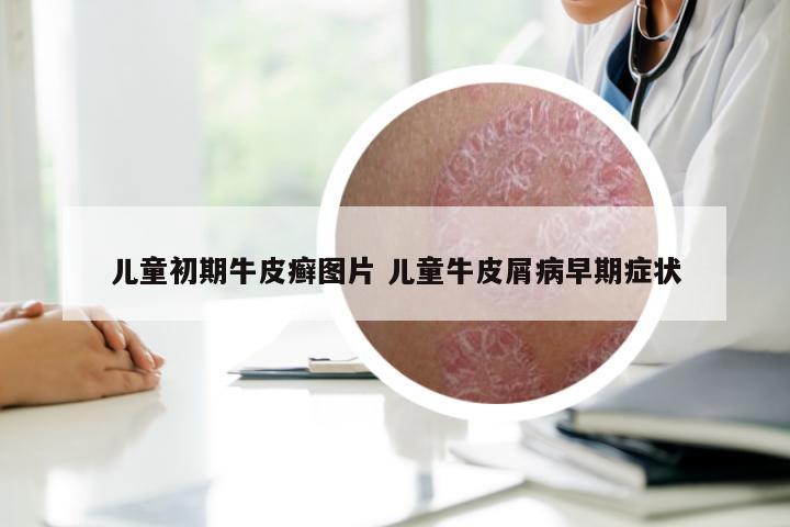儿童初期牛皮癣图片 儿童牛皮屑病早期症状