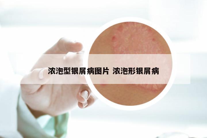 浓泡型银屑病图片 浓泡形银屑病
