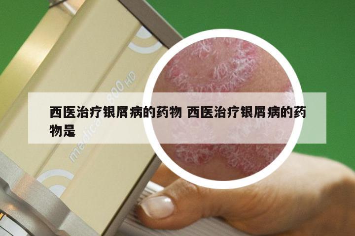 西医治疗银屑病的药物 西医治疗银屑病的药物是