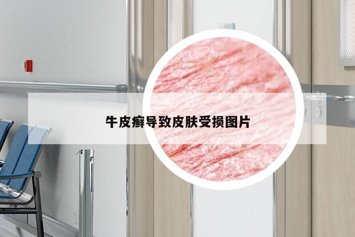 牛皮癣导致皮肤受损图片