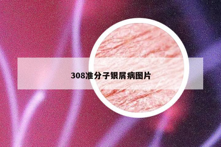 308准分子银屑病图片