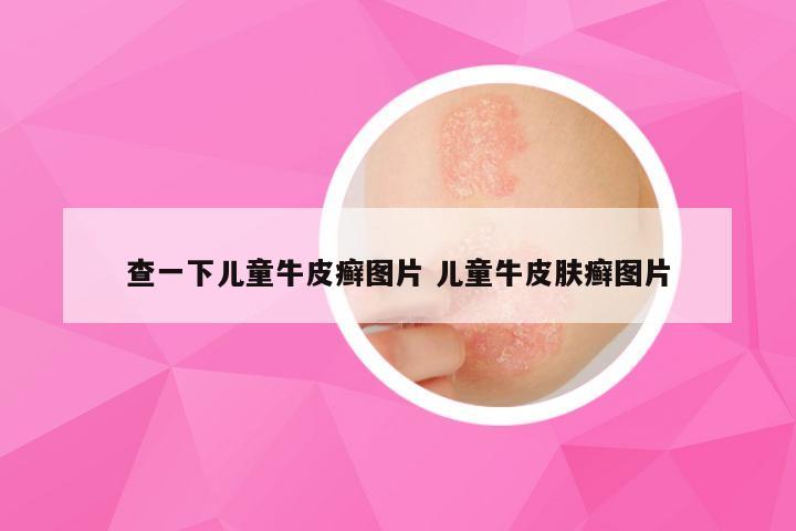 查一下儿童牛皮癣图片 儿童牛皮肤癣图片