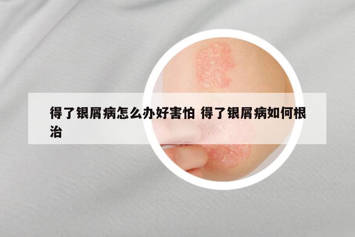 得了银屑病怎么办好害怕 得了银屑病如何根治