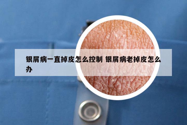 银屑病一直掉皮怎么控制 银屑病老掉皮怎么办