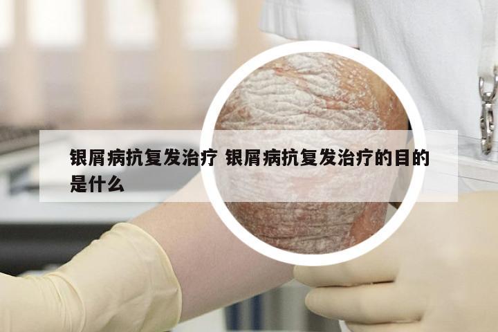银屑病抗复发治疗 银屑病抗复发治疗的目的是什么