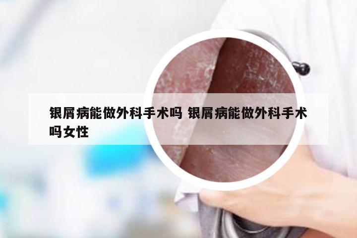 银屑病能做外科手术吗 银屑病能做外科手术吗女性