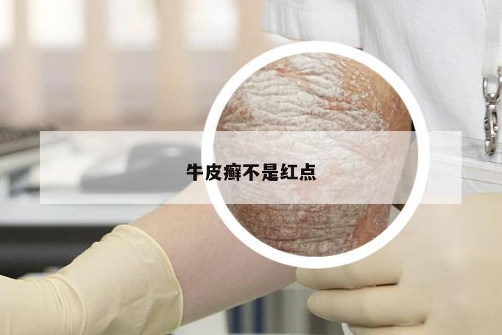 牛皮癣不是红点