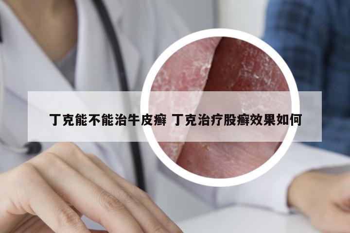 丁克能不能治牛皮癣 丁克治疗股癣效果如何