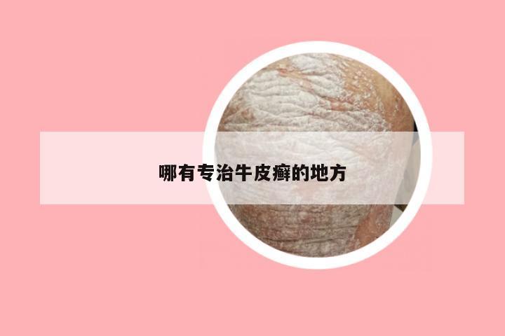 哪有专治牛皮癣的地方