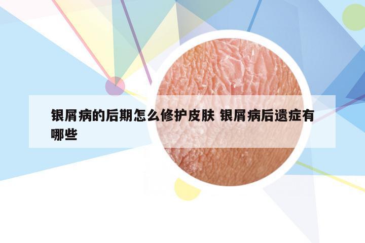 银屑病的后期怎么修护皮肤 银屑病后遗症有哪些