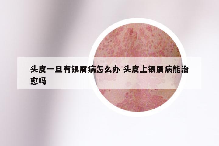 头皮一旦有银屑病怎么办 头皮上银屑病能治愈吗