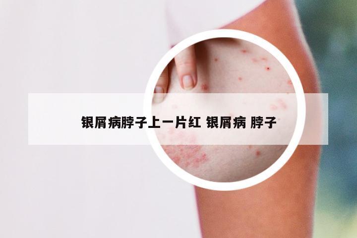 银屑病脖子上一片红 银屑病 脖子