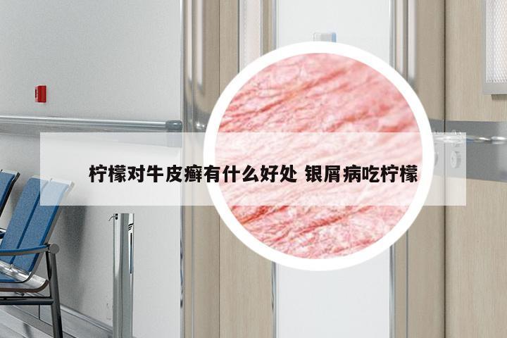 柠檬对牛皮癣有什么好处 银屑病吃柠檬