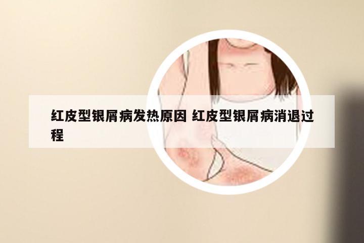 红皮型银屑病发热原因 红皮型银屑病消退过程