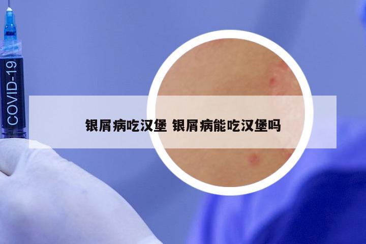 银屑病吃汉堡 银屑病能吃汉堡吗