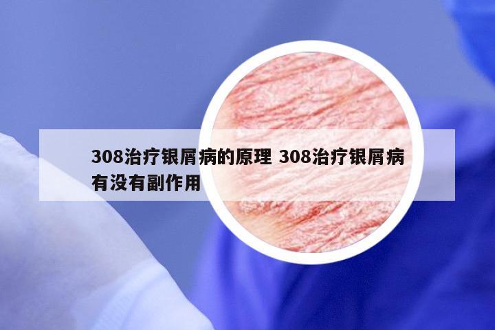 308治疗银屑病的原理 308治疗银屑病有没有副作用