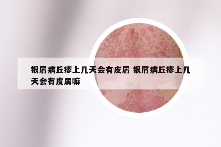 银屑病丘疹上几天会有皮屑 银屑病丘疹上几天会有皮屑嘛