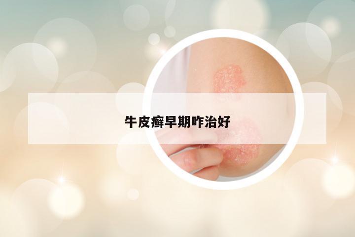 牛皮癣早期咋治好