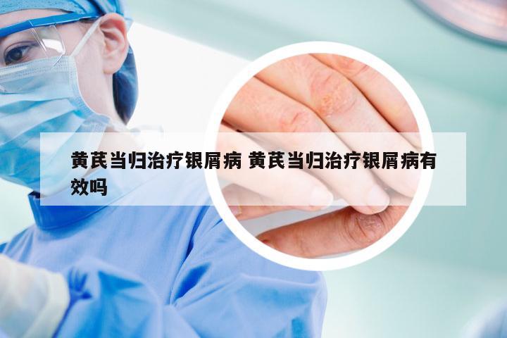 黄芪当归治疗银屑病 黄芪当归治疗银屑病有效吗