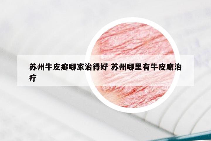 苏州牛皮癣哪家治得好 苏州哪里有牛皮廨治疗