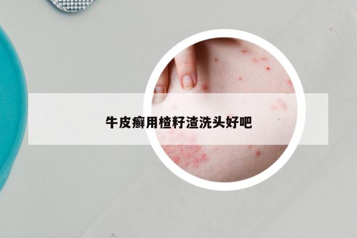 牛皮癣用楂籽渣洗头好吧