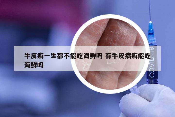 牛皮癣一生都不能吃海鲜吗 有牛皮病癣能吃海鲜吗