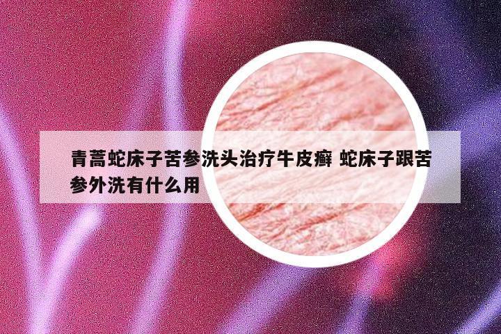 青蒿蛇床子苦参洗头治疗牛皮癣 蛇床子跟苦参外洗有什么用