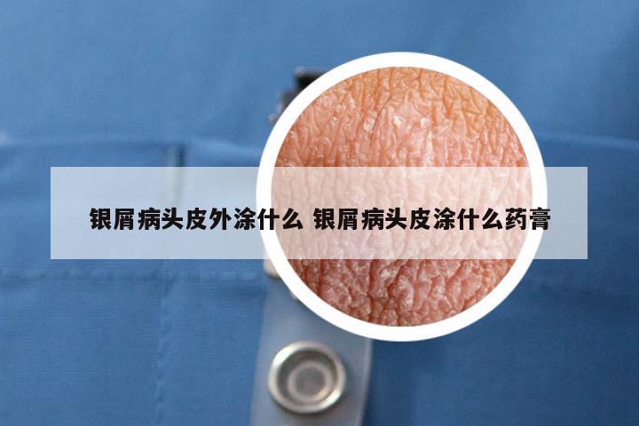 银屑病头皮外涂什么 银屑病头皮涂什么药膏