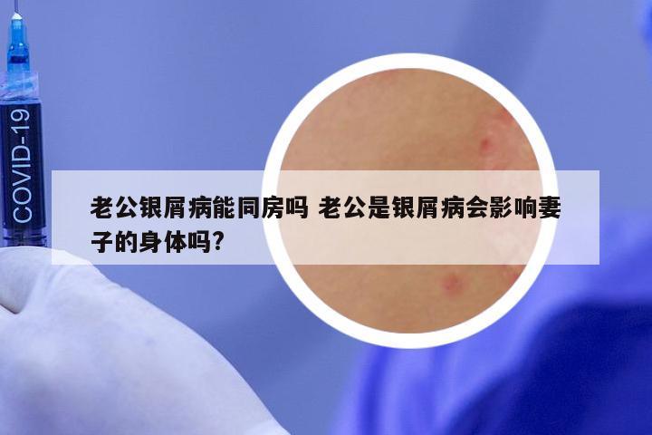 老公银屑病能同房吗 老公是银屑病会影响妻子的身体吗?