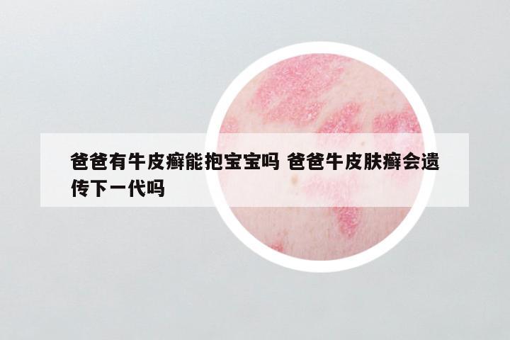 爸爸有牛皮癣能抱宝宝吗 爸爸牛皮肤癣会遗传下一代吗