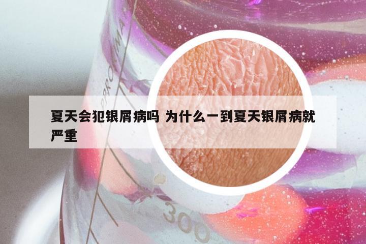 夏天会犯银屑病吗 为什么一到夏天银屑病就严重