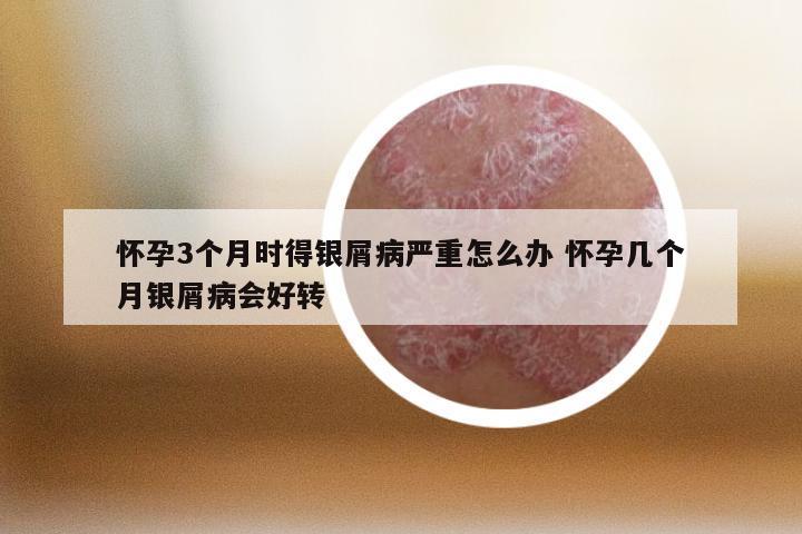 怀孕3个月时得银屑病严重怎么办 怀孕几个月银屑病会好转