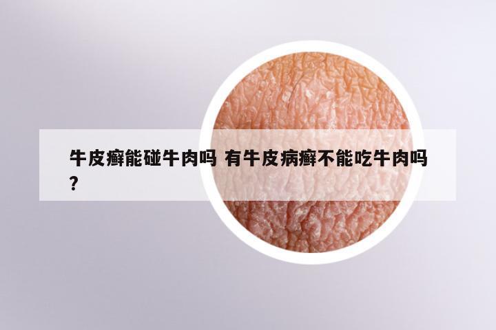 牛皮癣能碰牛肉吗 有牛皮病癣不能吃牛肉吗?