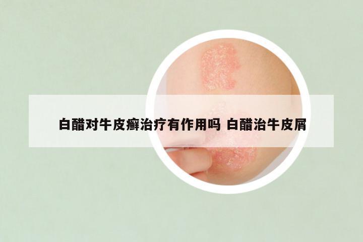 白醋对牛皮癣治疗有作用吗 白醋治牛皮屑