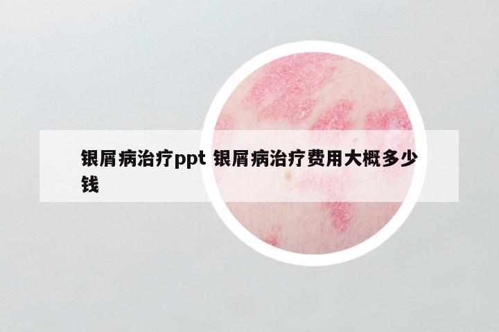 银屑病治疗ppt 银屑病治疗费用大概多少钱