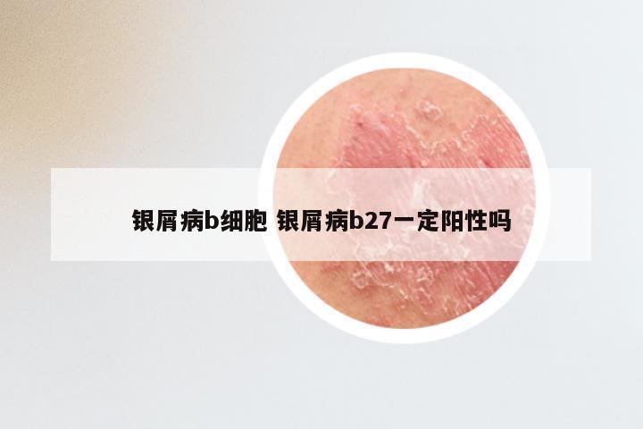 银屑病b细胞 银屑病b27一定阳性吗