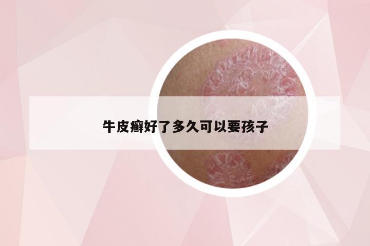 牛皮癣好了多久可以要孩子