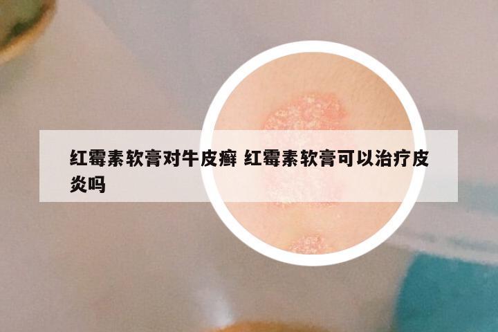 红霉素软膏对牛皮癣 红霉素软膏可以治疗皮炎吗